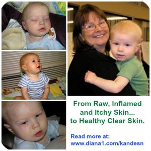 Kandesn Healthy Skin Eczema story Sunrider NuPlus and Calli